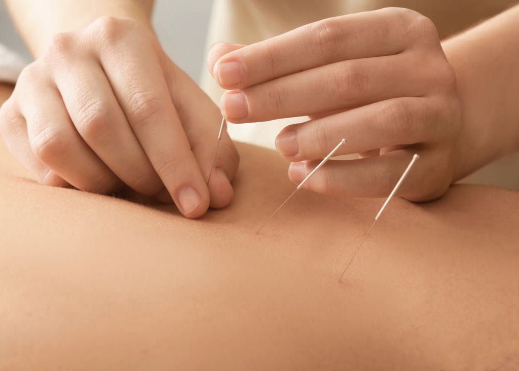 
Acupuncture for pain relief