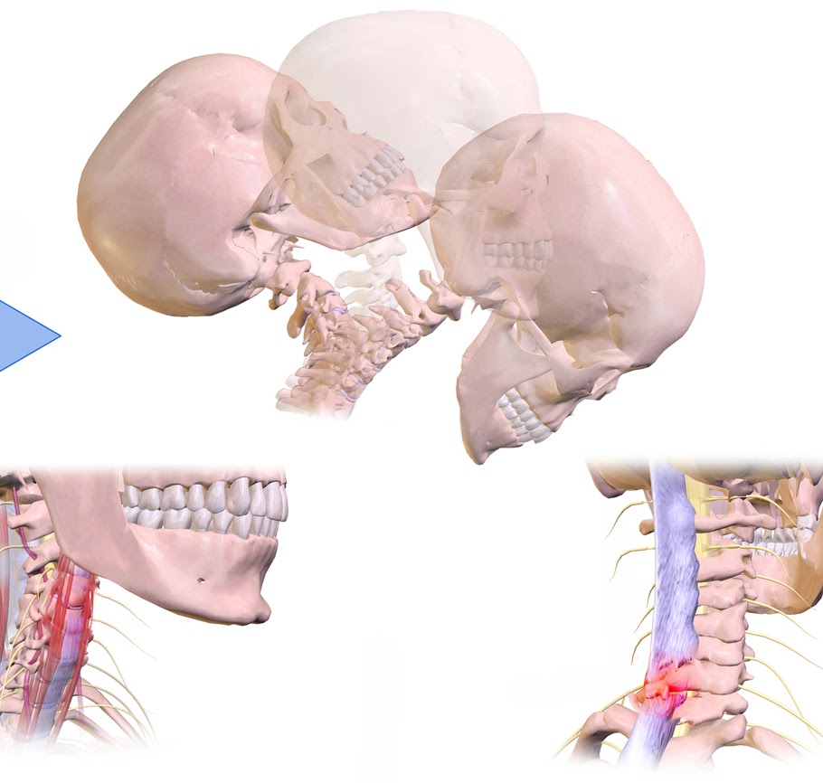 What is the Best Treatment for Whiplash Injuries?
