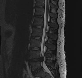 What is Spinal Instability?