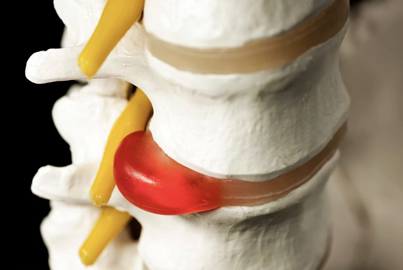 Slipped disc