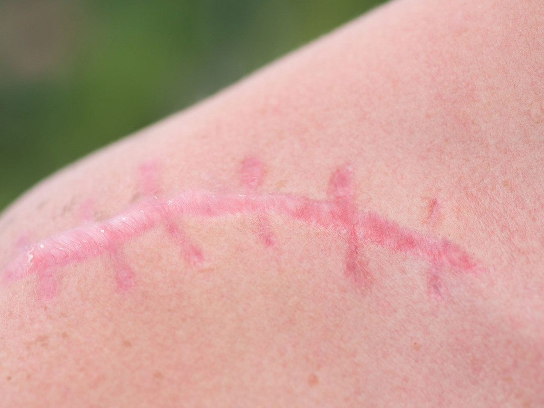 TRUSTED SCAR TREATMENT