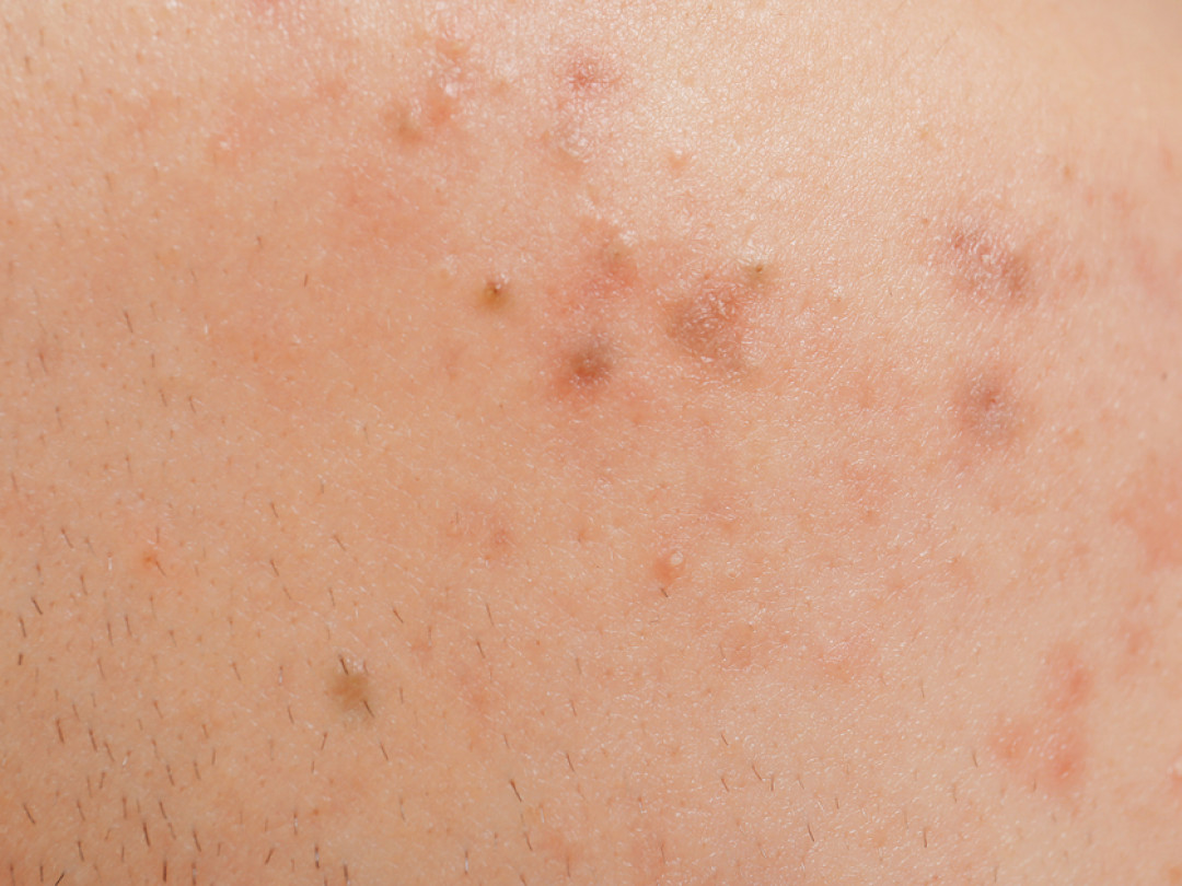 ACNE TREATMENT