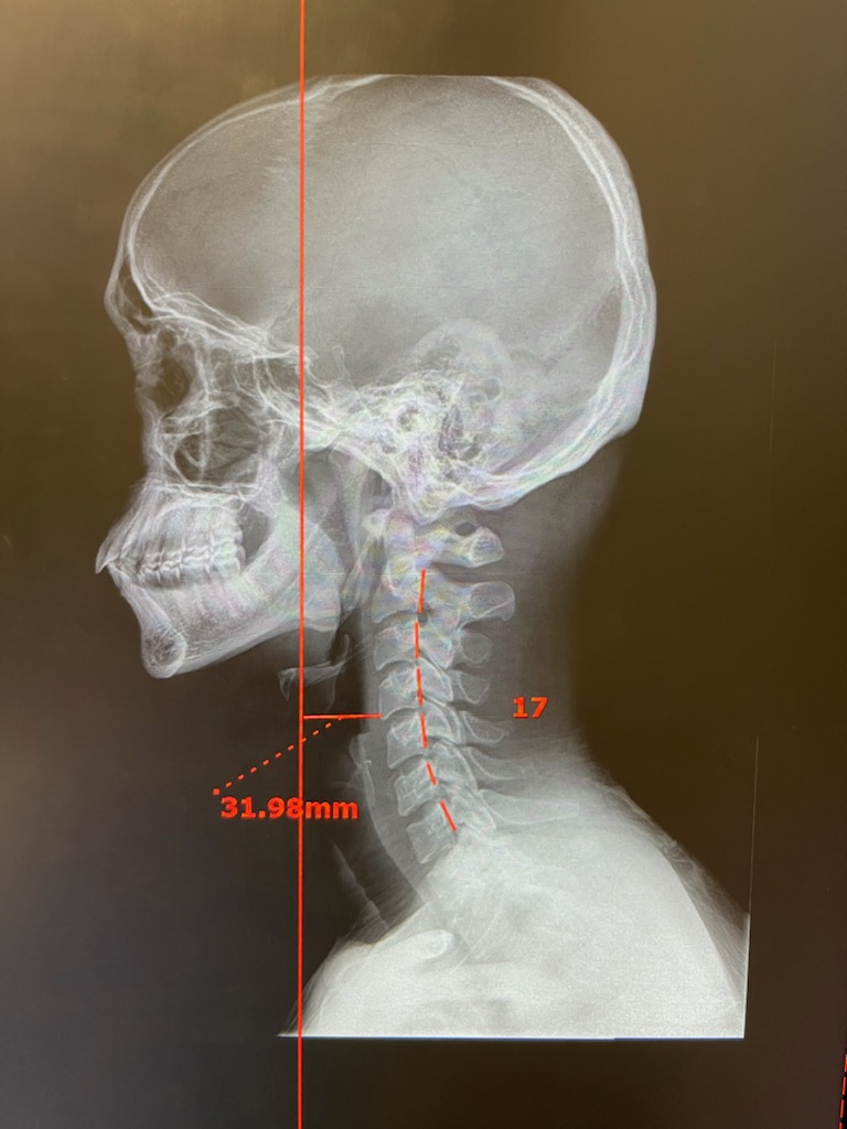 Why a Spinal Assessment Before Adjustment Matters