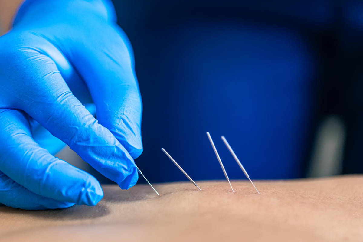 Dry Needling (coming soon)!