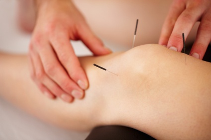 Dry Needling Q&A