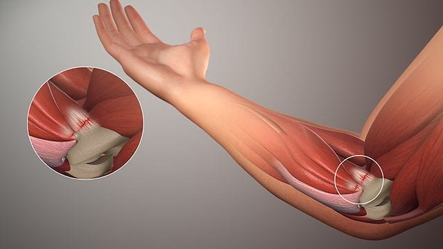 Tendonitis Q&A