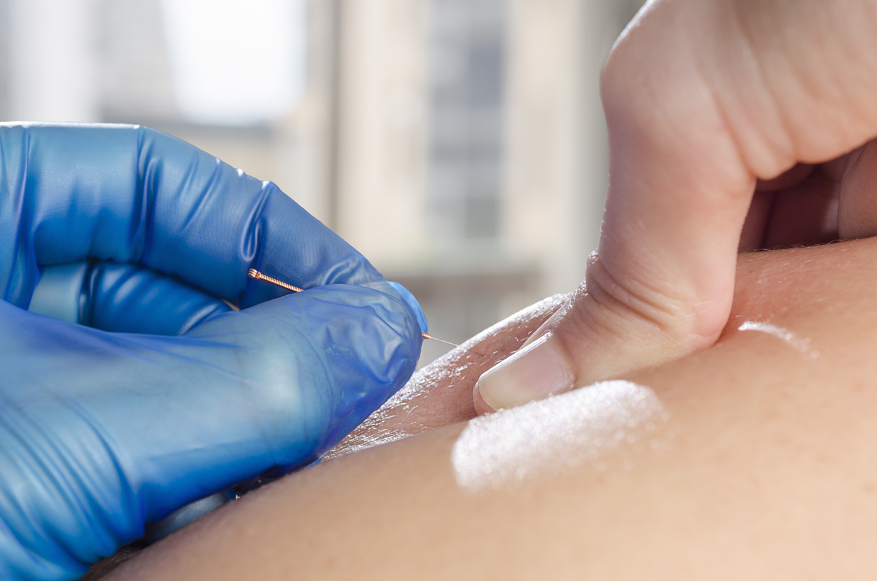 Dry Needling