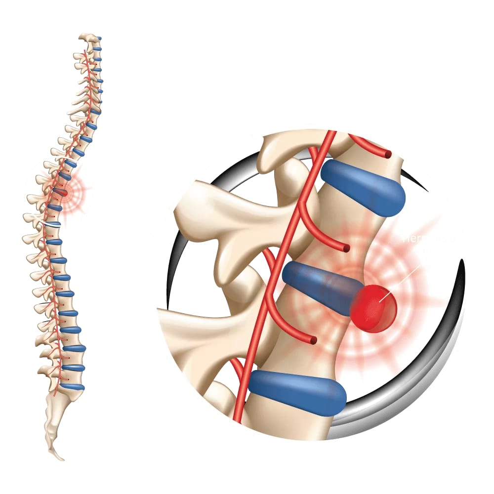 Disc Therapy