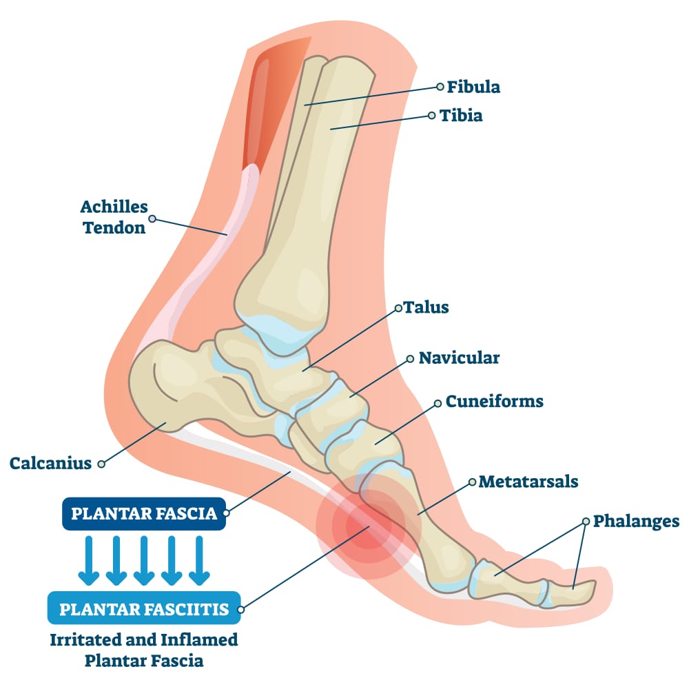 Plantar Fasciitis

