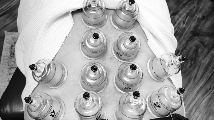 Cupping Therapy