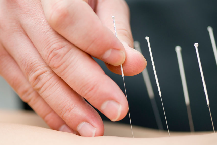 Trigger Point Acupuncture & Dry Needling
