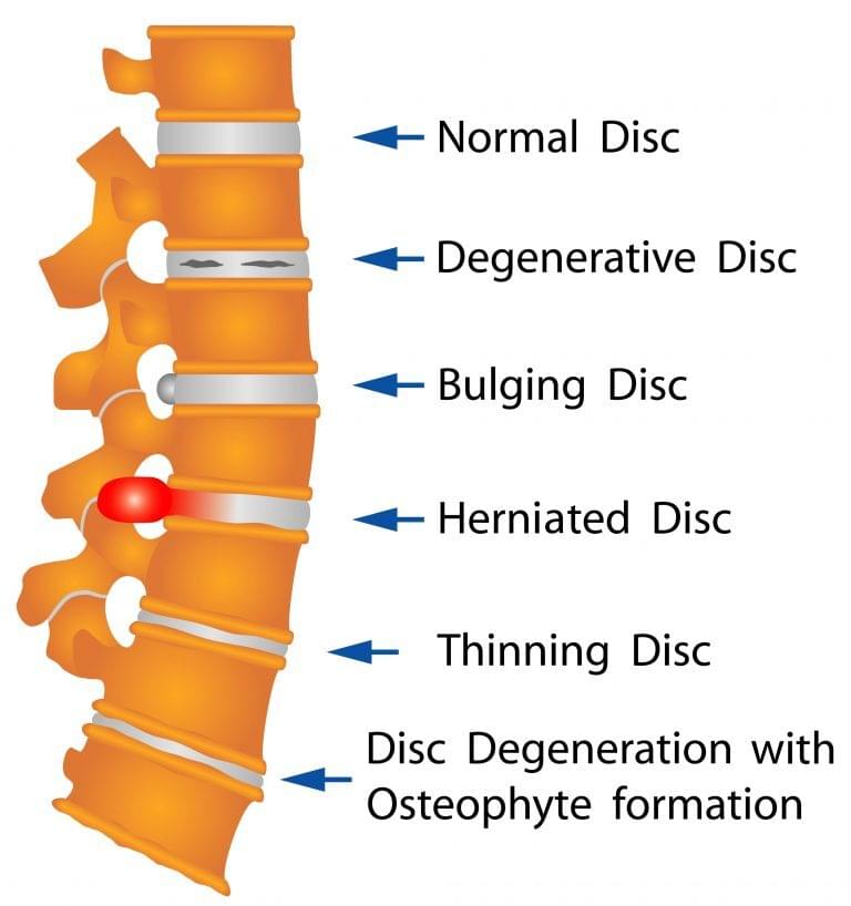 What Are The Most Common Causes of Disc Disorders?
