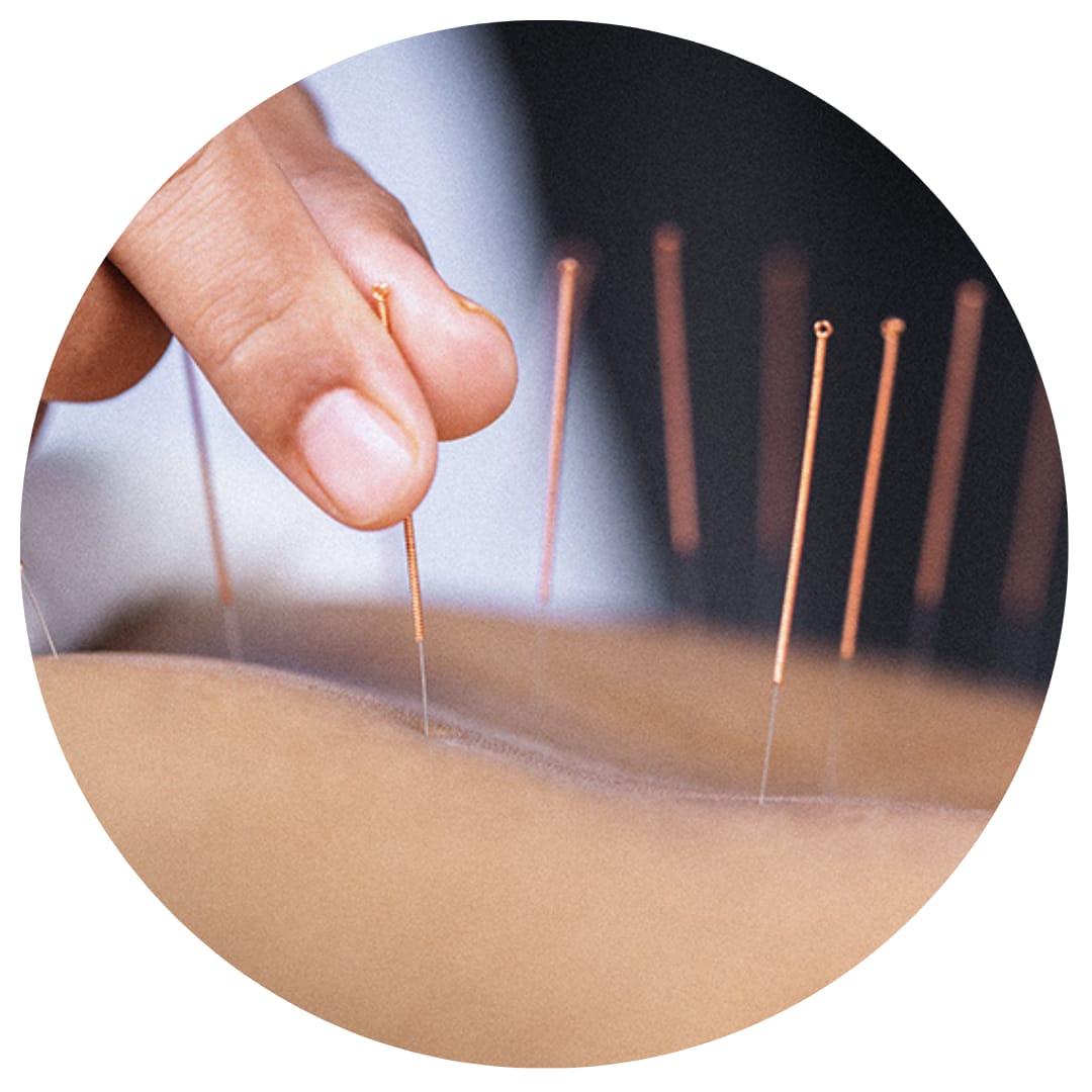 Acupuncture