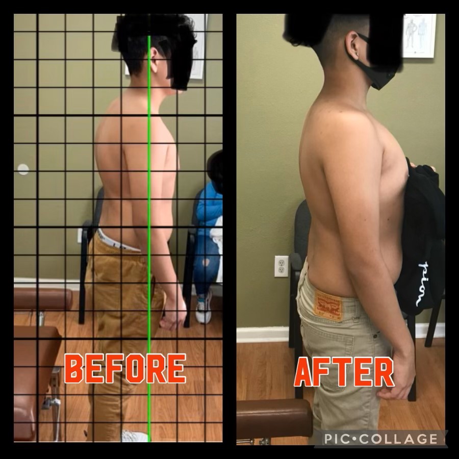 Forward Head Posture