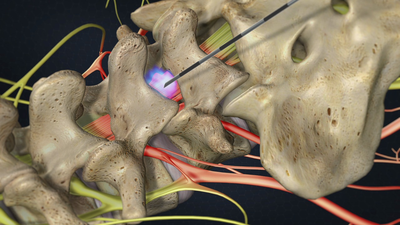 Treatments for Spine Pain