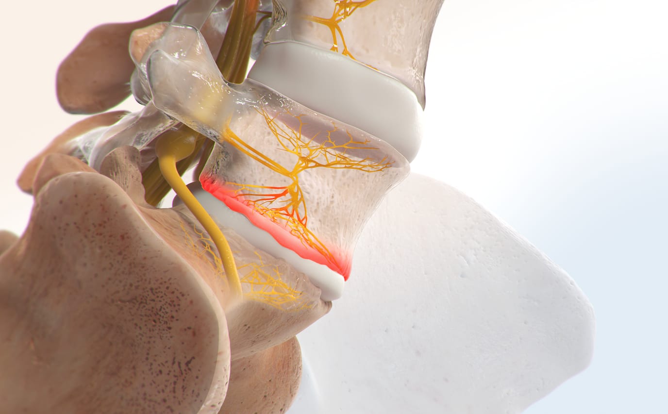 INTRACEPT® PROCEDURE