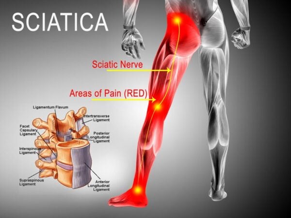Treatments for Nerve Pain