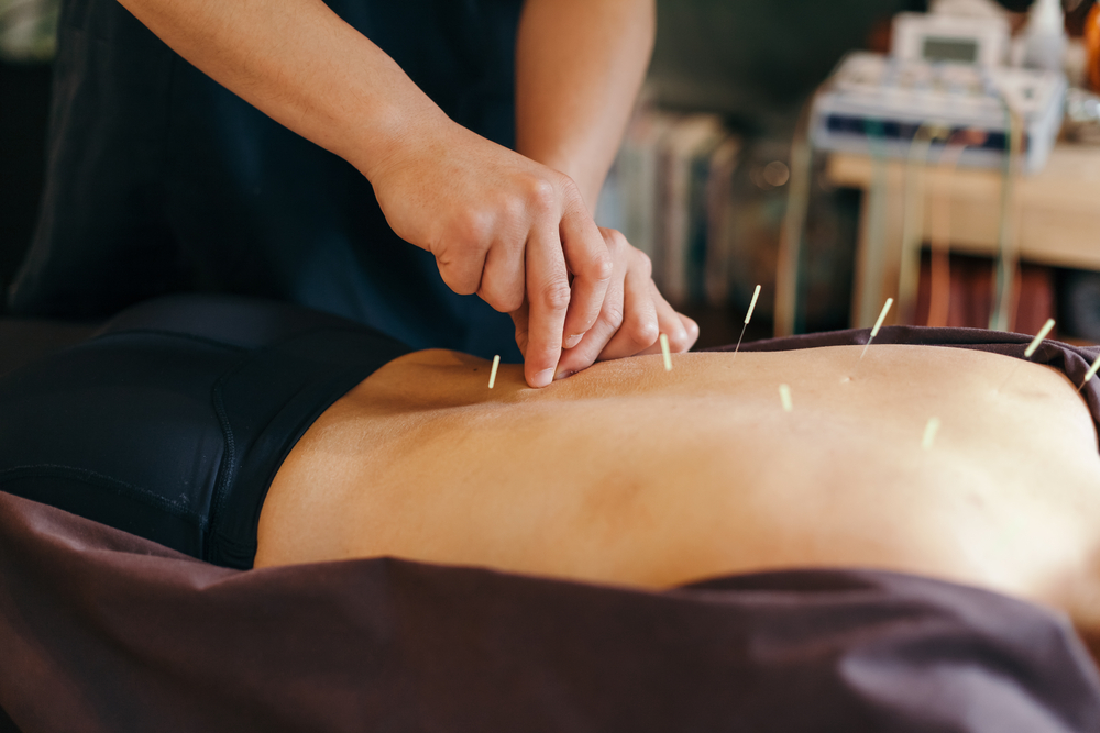 Acupuncture