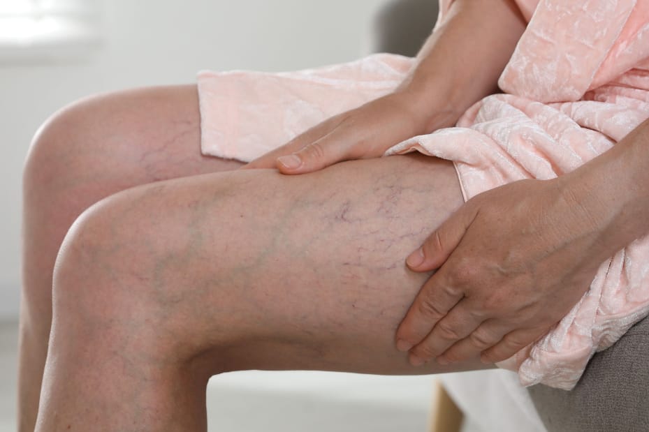 Vein Care 