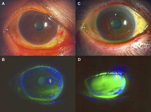 Understanding Dry Eye Syndrome: Why Your Eyes Feel Dry and What You Can Do