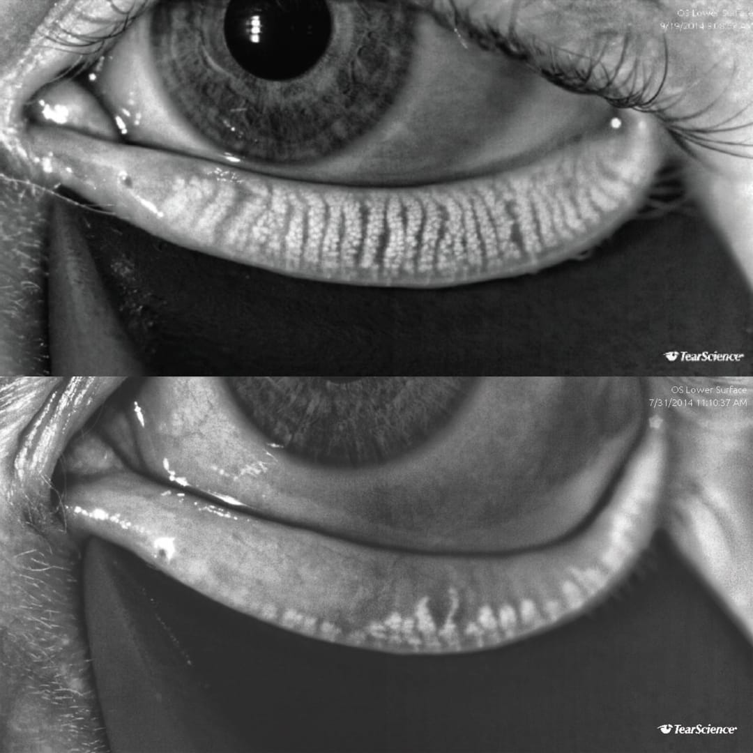 Dry Eye