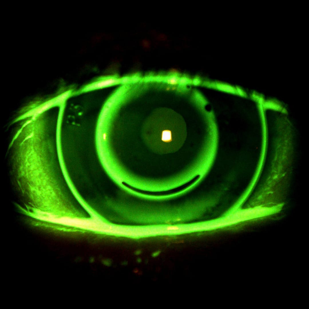 Contact Lenses