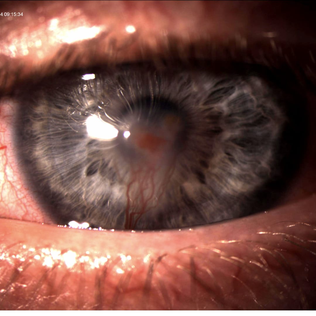 Emergency Eye Care