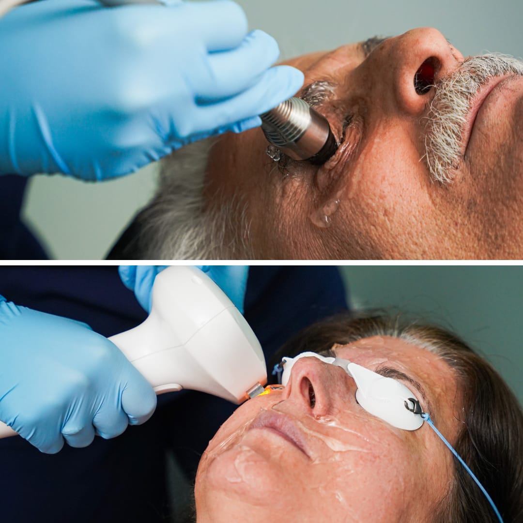 Dry Eye Treatment
