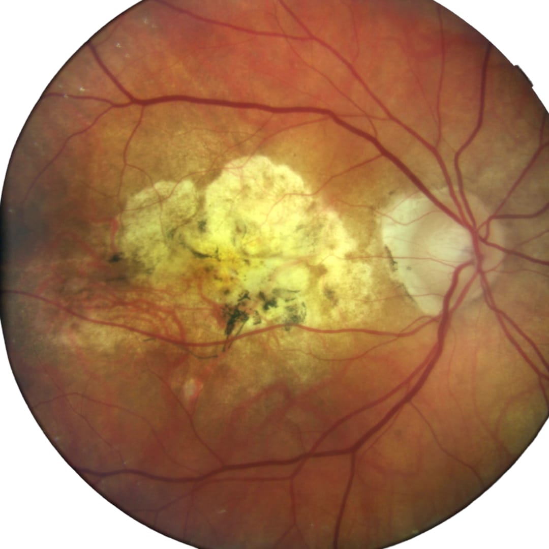 Macular Degeneration