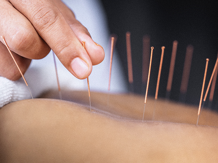Dry Needling