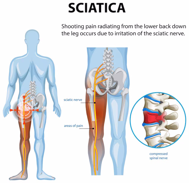 Sciatica